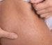 how to get rid of stretch marks
